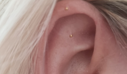 Acupunctuur